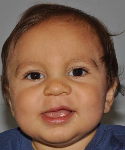 Cleft Lip Palate Before & After Patient #4976