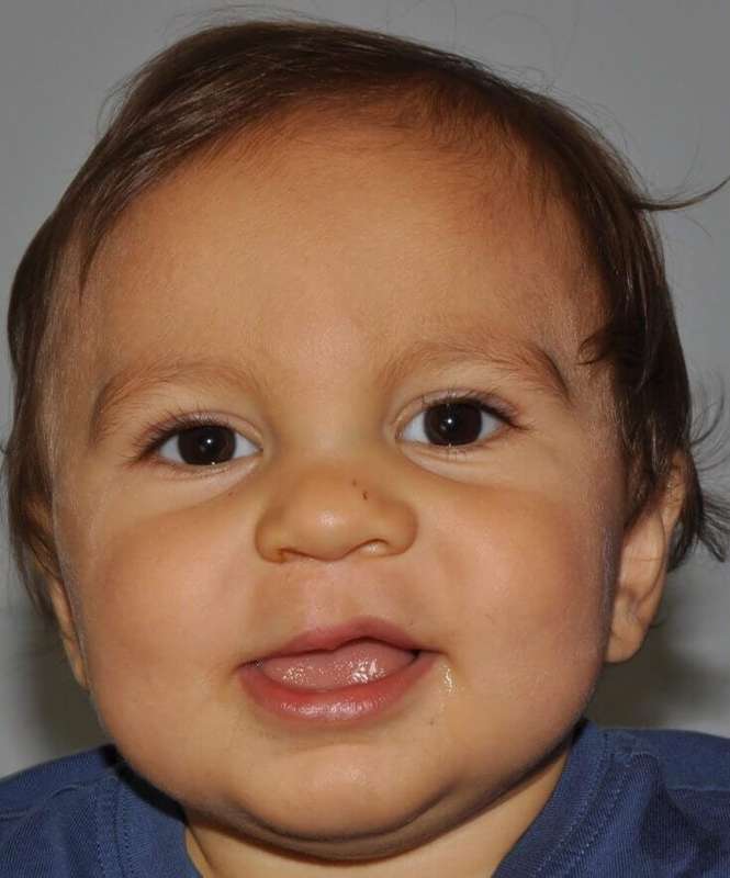Cleft Lip Palate Before & After Patient #4976