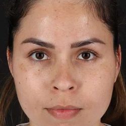 Cosmetic Injectables Before & After Patient #4990