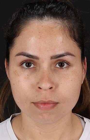 Cosmetic Injectables Before & After Patient #4990