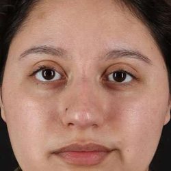 Cosmetic Injectables Before & After Patient #5001