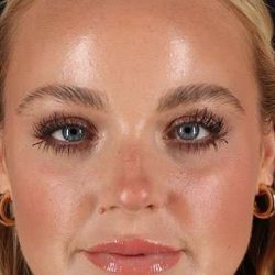 Cosmetic Injectables Before & After Patient #5004