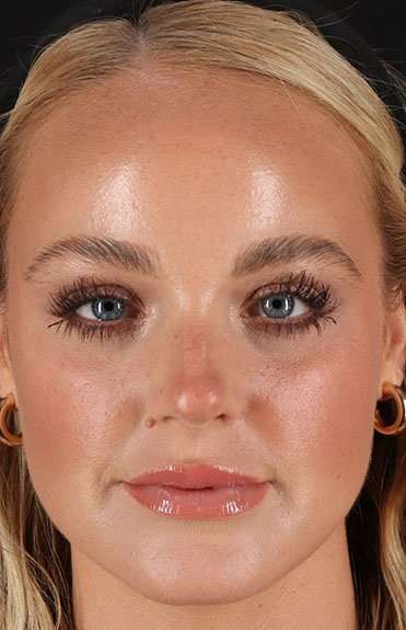 Cosmetic Injectables Before & After Patient #5004