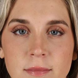 Cosmetic Injectables Before & After Patient #5007