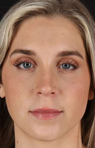 Cosmetic Injectables Before & After Patient #5007