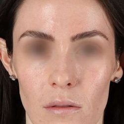 Cosmetic Injectables Before & After Patient #5016