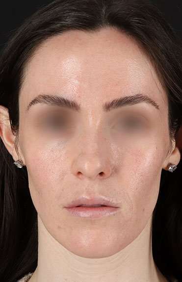 Cosmetic Injectables Before & After Patient #5016