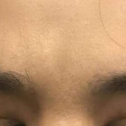 Cosmetic Injectables Before & After Patient #5019