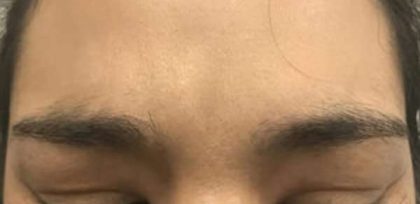Cosmetic Injectables Before & After Patient #5019