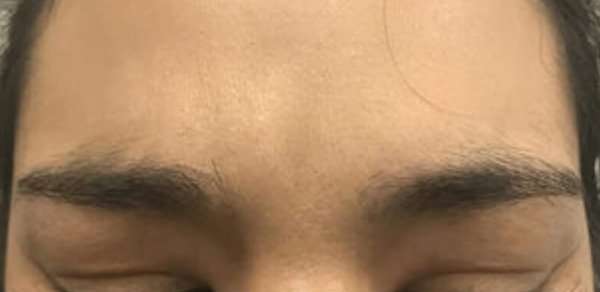 Cosmetic Injectables Before & After Patient #5019