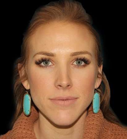 Cosmetic Injectables Before & After Patient #5026