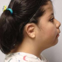 Ear Reconstruction / Microtia Before & After Patient #5031
