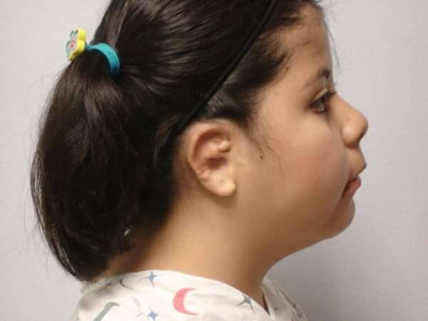 Ear Reconstruction / Microtia Before & After Patient #5031