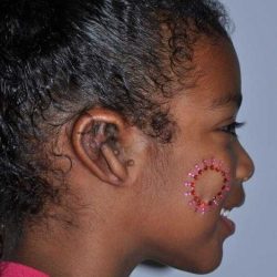 Ear Reconstruction / Microtia Before & After Patient #5034