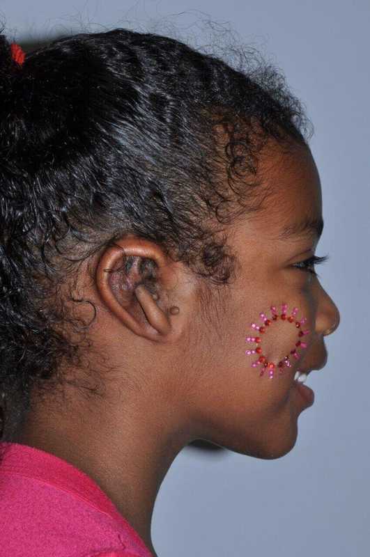 Ear Reconstruction / Microtia Before & After Patient #5034