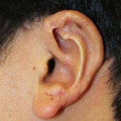 Ear Reconstruction / Microtia Before & After Patient #5037