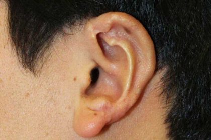 Ear Reconstruction / Microtia Before & After Patient #5037
