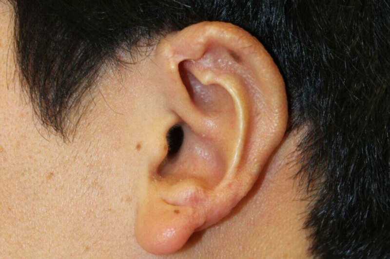 Ear Reconstruction / Microtia Before & After Patient #5037