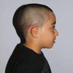 Ear Reconstruction / Microtia Before & After Patient #5040