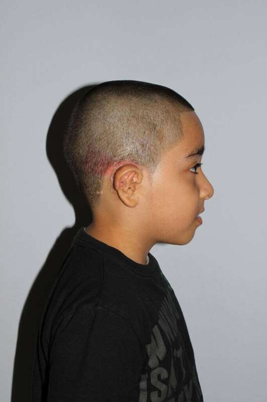 Ear Reconstruction / Microtia Before & After Patient #5040