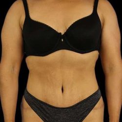 Abdominoplasty (Tummy Tuck) Before & After Patient #601
