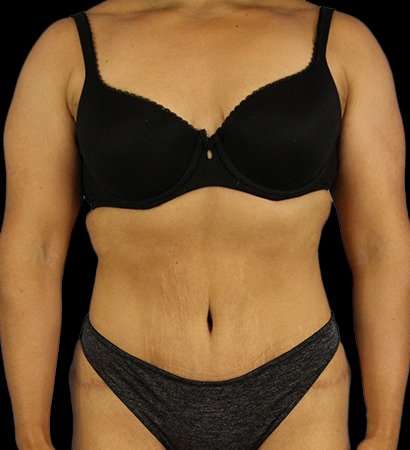 Abdominoplasty (Tummy Tuck) Before & After Patient #601