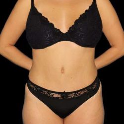 Abdominoplasty (Tummy Tuck) Before & After Patient #1083