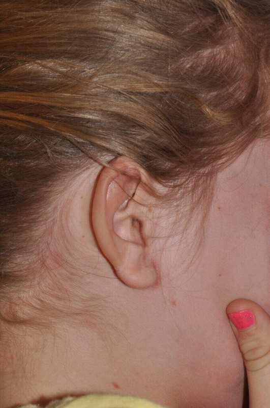 Ear Reconstruction / Microtia Before & After Patient #5045