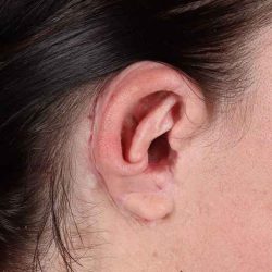 Ear Reconstruction / Microtia Before & After Patient #5048