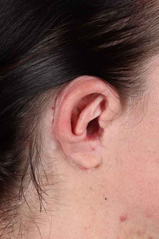Ear Reconstruction / Microtia Before & After Patient #5048