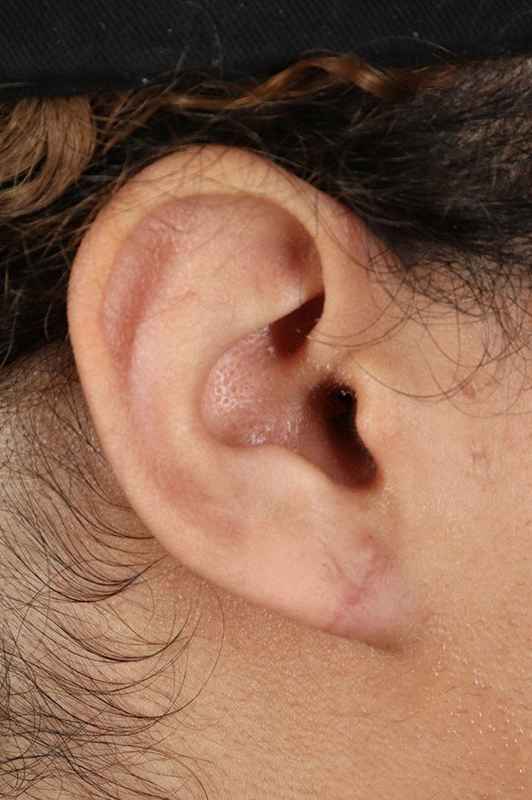 Earlobe Repair Before & After Patient #5053