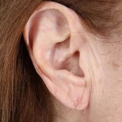 Earlobe Repair Before & After Patient #5067