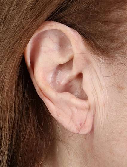 Earlobe Repair Before & After Patient #5067
