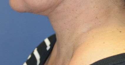 Facelift Before & After Patient #5070