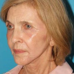 Facelift Before & After Patient #5075