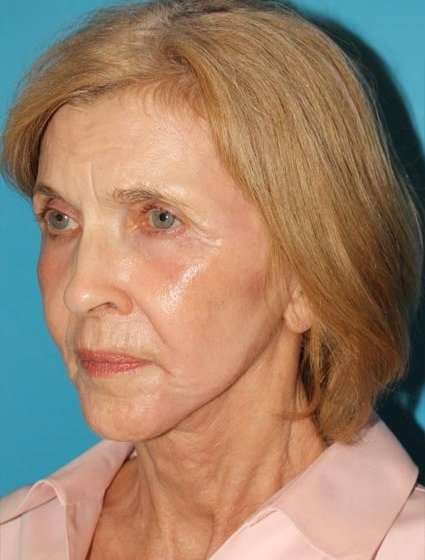 Facelift Before & After Patient #5075
