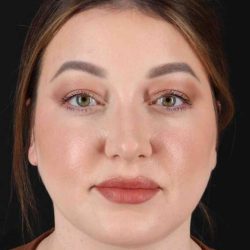 Facelift Before & After Patient #5097