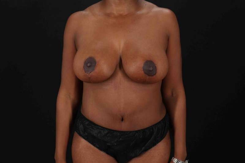 Abdominoplasty (Tummy Tuck) Before & After Patient #1099