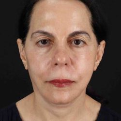 Facelift Before & After Patient #5141