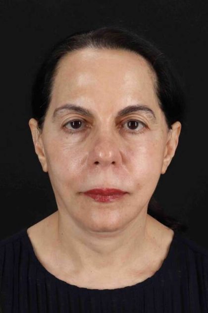 Facelift Before & After Patient #5141