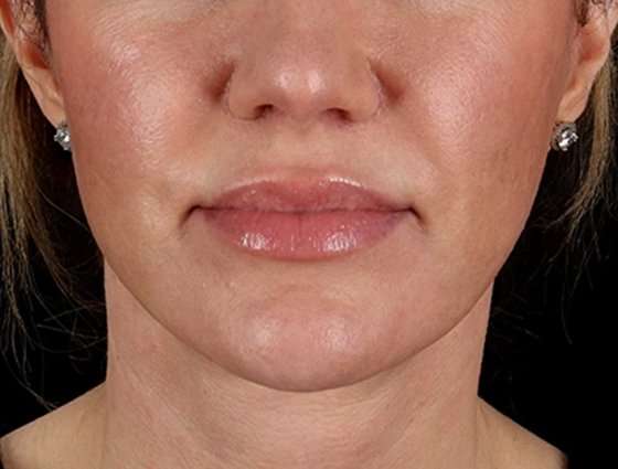 Facelift Before & After Patient #5185