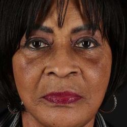 Facelift Before & After Patient #5196