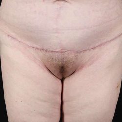 Monsplasty Before & After Patient #1117