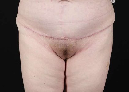 Monsplasty Before & After Patient #1117