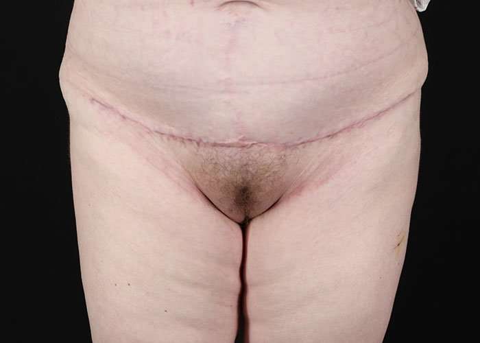 Monsplasty Before & After Patient #1117