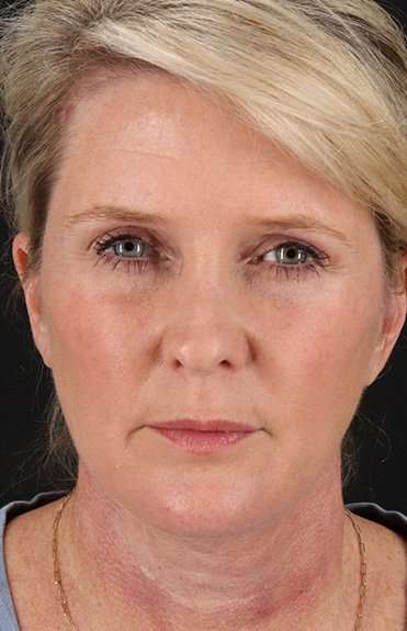 Facelift Before & After Patient #5229