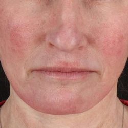 Facelift Before & After Patient #5240