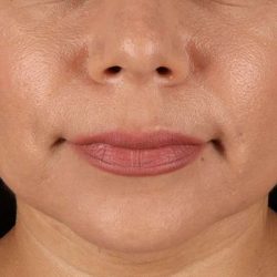 Facelift Before & After Patient #5251