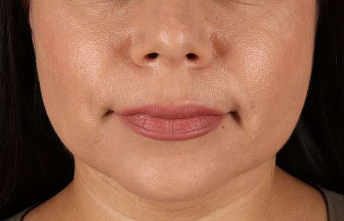 Facelift Before & After Patient #5251