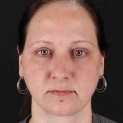 Facelift Before & After Patient #5273
